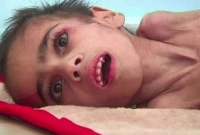 বিধ্বস্ত ইয়েমেনে ক্ষুধায় সাত বছরের ছেলের ওজন ৭ কেজি!