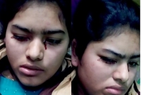 দুরারোগ্য ব্যাধিতে আক্রান্ত মুক্তা, চোখ দিয়ে জল নয়, ঝরে রক্তধারা, নাক ও মুখ দিয়েও আসে রক্ত!