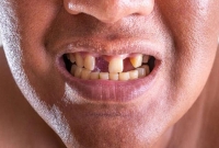 ফোকলা দাঁতের মানুষদের জন্যে সুখবর