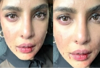 নিজের ক্ষতবিক্ষত মুখের ছবি শেয়ার করলেন প্রিয়াঙ্কা! ঘটনা কী?