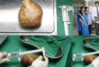 প্রায় ১ কেজি ওজনের পাথর মিলল কিডনিতে, বিশ্ব রেকর্ড!