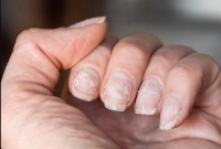 ৫ লক্ষণ শরীরে কোলেস্টেরল বাড়ার