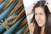 লেবু-রসুন দিয়ে দূর করুন মাথার উকুন