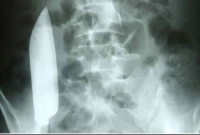 অস্ত্রোপচারের পর পেটের ভেতর মিলল ছুরি!