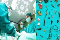 অস্ত্রোপচারের পর পেট থেকে বের করা হলো ১০০টি ধাতব বস্তু!