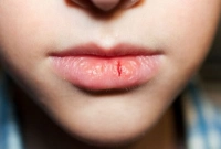 ঘরোয়া উপায়ে দূর করুন শীতে ঠোঁট ফাটার সমস্যা