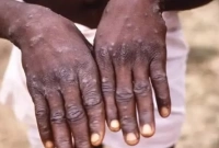 নতুন এক উদ্বেগের নাম এমপক্স! যেভাবে ছড়ায় এই রোগ, কঙ্গোতে ৪৫০ জনের মৃত্যু