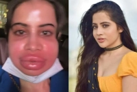  উরফি জাভেদের ঠোঁটের বেহাল দশা!