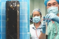 ৩০-বছর-পর-রোগীর-পেট-থেকে-বের-করা-হলো-সিগারেটে-আগুন-ধরানোর-লাইটার