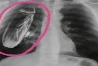 রোগীর-বুকের-ভেতরে-তেলাপোকা-শনাক্ত-জানা-গেল-আসল-কাহিনী